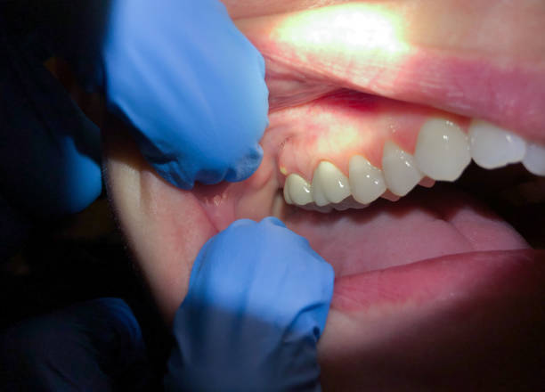 Best Emergency Dental Extractions in Interlaken, CA